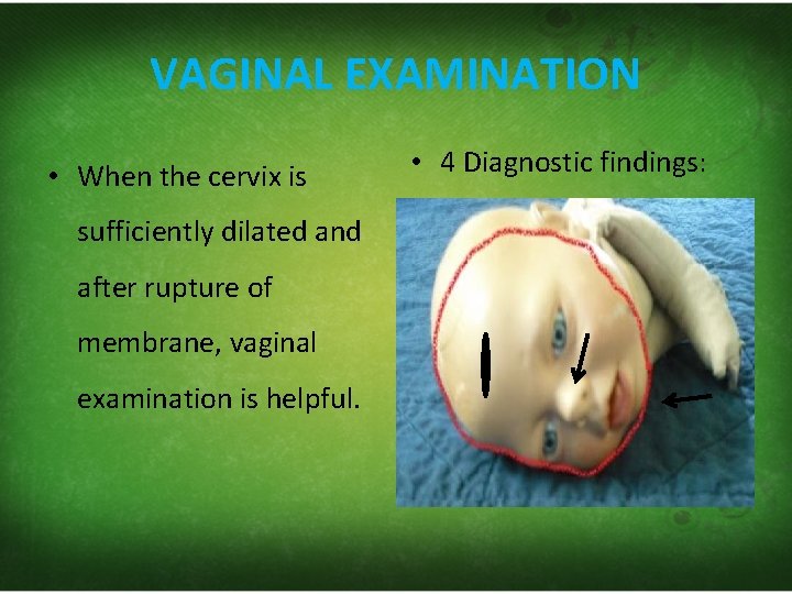 VAGINAL EXAMINATION • When the cervix is sufficiently dilated and after rupture of membrane,