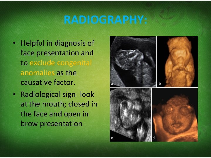 RADIOGRAPHY: • Helpful in diagnosis of face presentation and to exclude congenital anomalies as