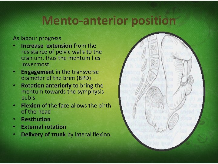 Mento-anterior position As labour progress • Increase extension from the resistance of pelvic walls