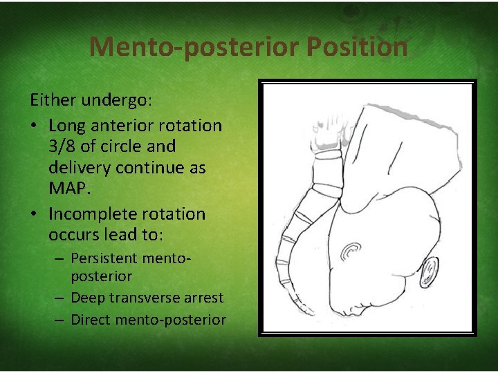 Mento-posterior Position Either undergo: • Long anterior rotation 3/8 of circle and delivery continue