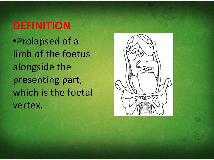 DEFINITION • Prolapsed of a limb of the foetus alongside the presenting part, which