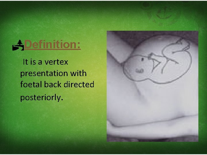  Definition: It is a vertex presentation with foetal back directed posteriorly. 