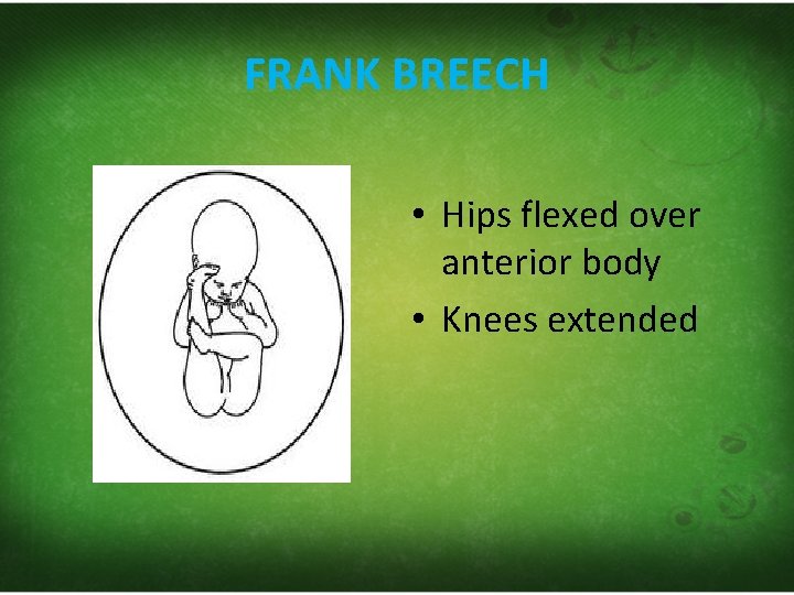 FRANK BREECH • Hips flexed over anterior body • Knees extended 