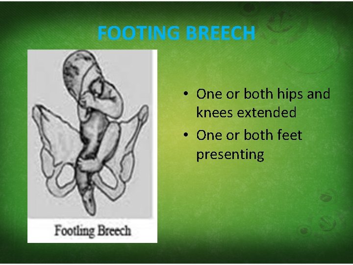 FOOTING BREECH • One or both hips and knees extended • One or both