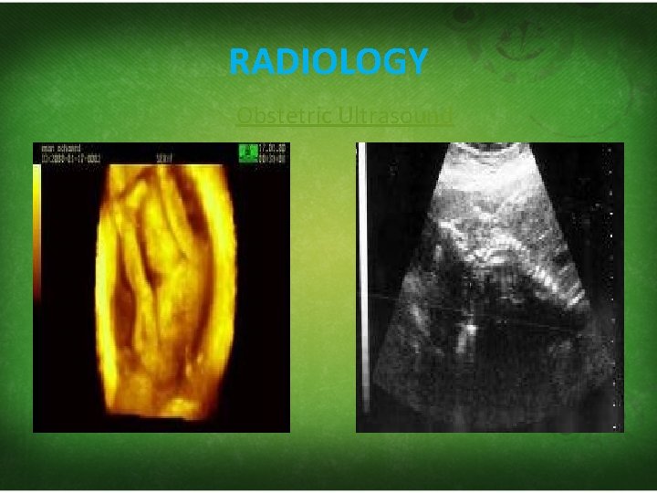 RADIOLOGY Obstetric Ultrasound 
