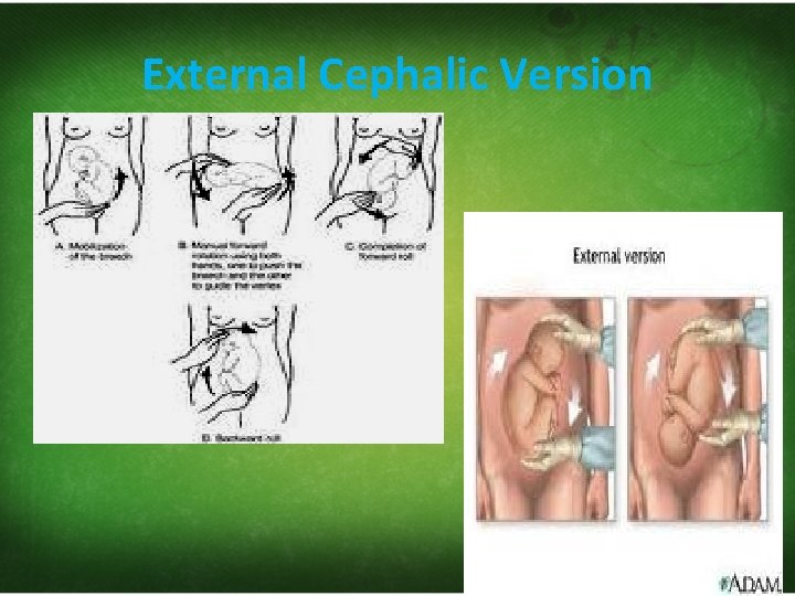 External Cephalic Version 
