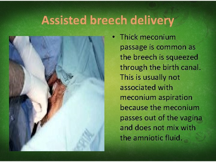 Assisted breech delivery • Thick meconium passage is common as the breech is squeezed