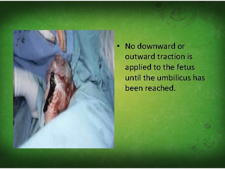  • No downward or outward traction is applied to the fetus until the