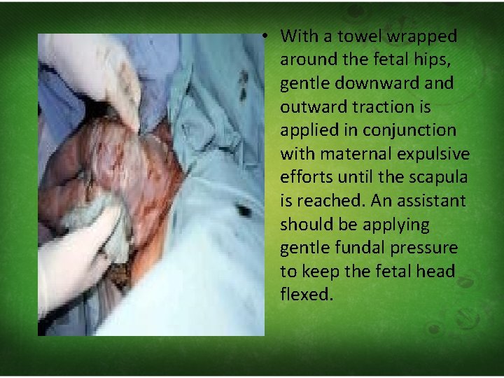 • With a towel wrapped around the fetal hips, gentle downward and outward