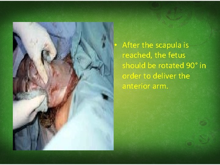  • After the scapula is reached, the fetus should be rotated 90° in