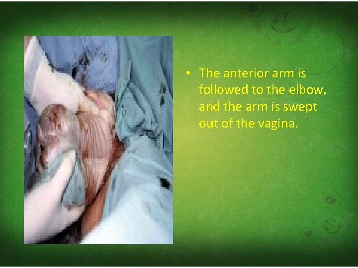  • The anterior arm is followed to the elbow, and the arm is