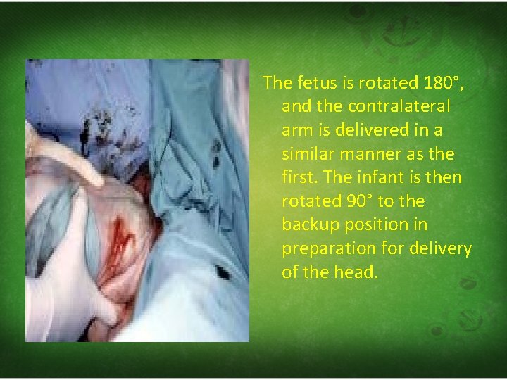 The fetus is rotated 180°, and the contralateral arm is delivered in a similar