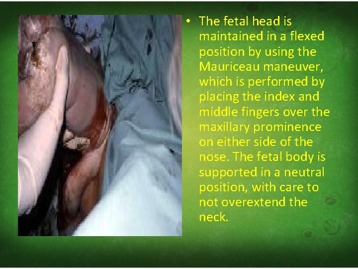  • The fetal head is maintained in a flexed position by using the