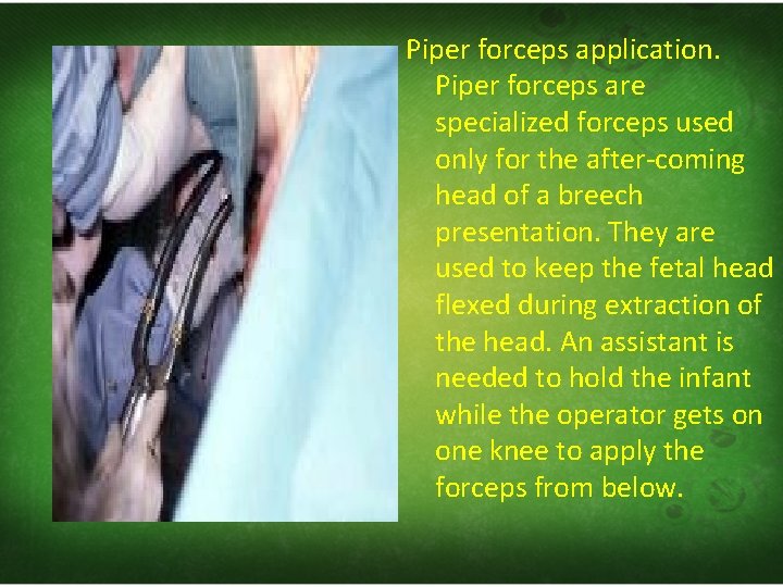 Piper forceps application. Piper forceps are specialized forceps used only for the after‐coming head