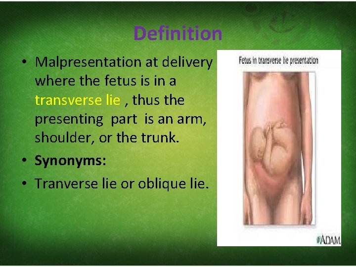 Definition • Malpresentation at delivery where the fetus is in a transverse lie ,