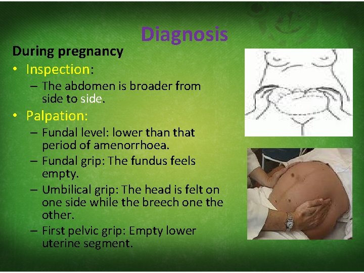 During pregnancy • Inspection: Diagnosis – The abdomen is broader from side to side.
