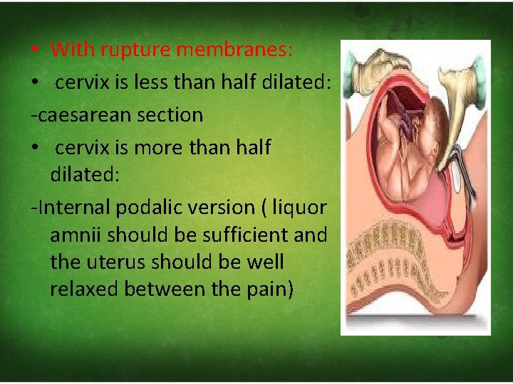  • With rupture membranes: • cervix is less than half dilated: ‐caesarean section