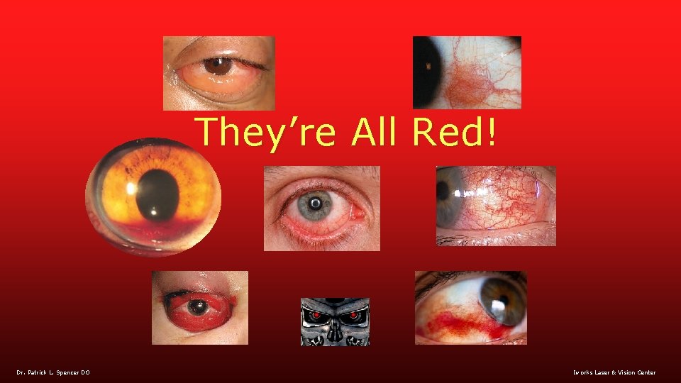 They’re All Red! Dr. Patrick L. Spencer DO Iworks Laser & Vision Center 