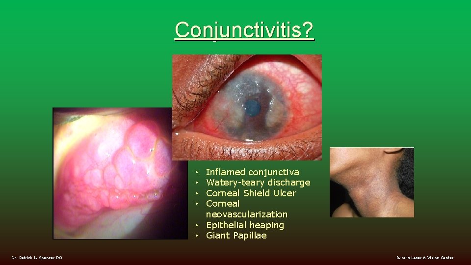 Conjunctivitis? Inflamed conjunctiva Watery-teary discharge Corneal Shield Ulcer Corneal neovascularization • Epithelial heaping •