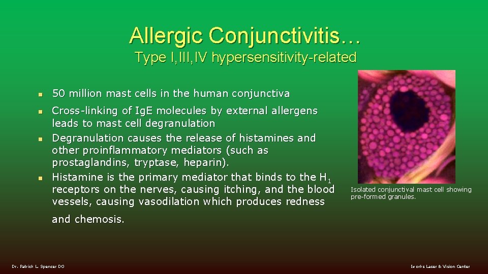 Allergic Conjunctivitis… Type I, III, IV hypersensitivity-related n n 50 million mast cells in