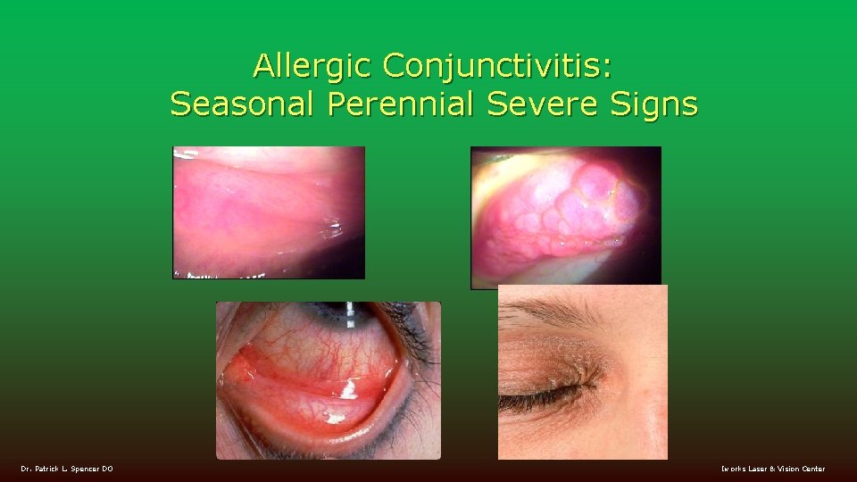 Allergic Conjunctivitis: Seasonal Perennial Severe Signs Dr. Patrick L. Spencer DO Iworks Laser &