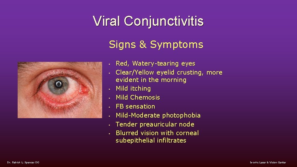 Viral Conjunctivitis Signs & Symptoms • • Dr. Patrick L. Spencer DO Red, Watery-tearing