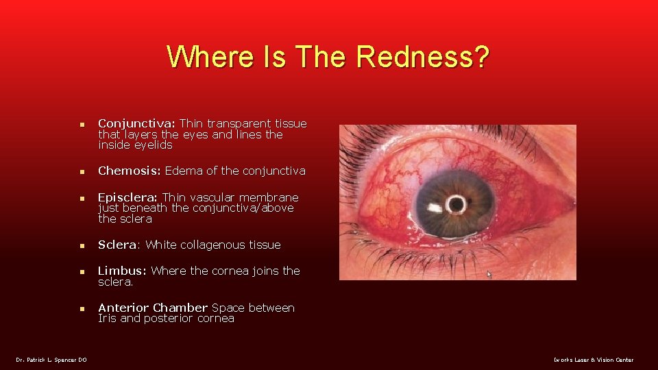 Where Is The Redness? n n n Conjunctiva: Thin transparent tissue that layers the