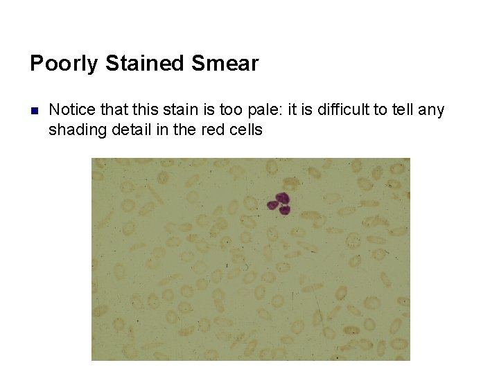 Poorly Stained Smear n Notice that this stain is too pale: it is difficult