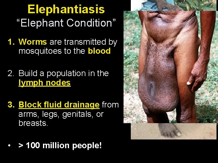 Elephantiasis “Elephant Condition” 1. Worms are transmitted by mosquitoes to the blood 2. Build