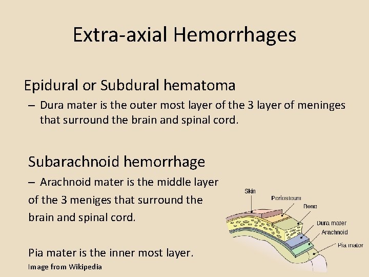 Extra-axial Hemorrhages Epidural or Subdural hematoma – Dura mater is the outer most layer