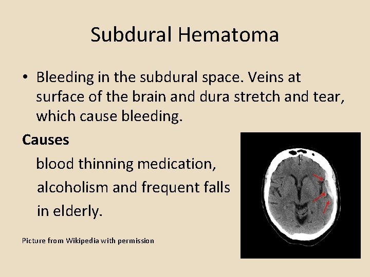Subdural Hematoma • Bleeding in the subdural space. Veins at surface of the brain