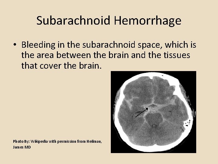 Subarachnoid Hemorrhage • Bleeding in the subarachnoid space, which is the area between the