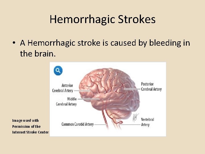 Hemorrhagic Strokes • A Hemorrhagic stroke is caused by bleeding in the brain. Image