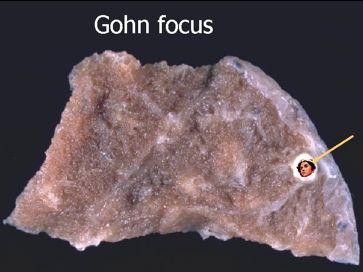 Gohn focus 