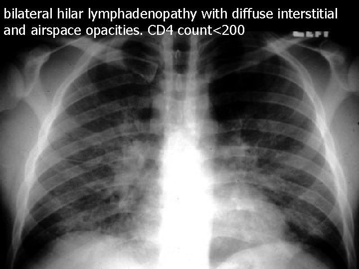 bilateral hilar lymphadenopathy with diffuse interstitial and airspace opacities. CD 4 count<200 