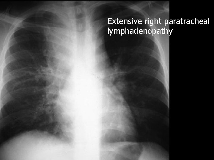 Extensive right paratracheal lymphadenopathy 