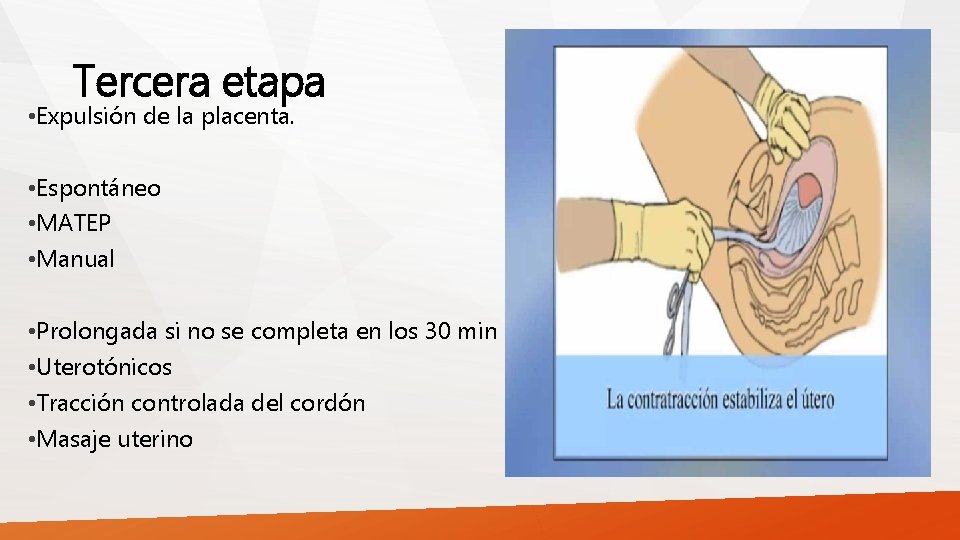 Tercera etapa • Expulsión de la placenta. • Espontáneo • MATEP • Manual •