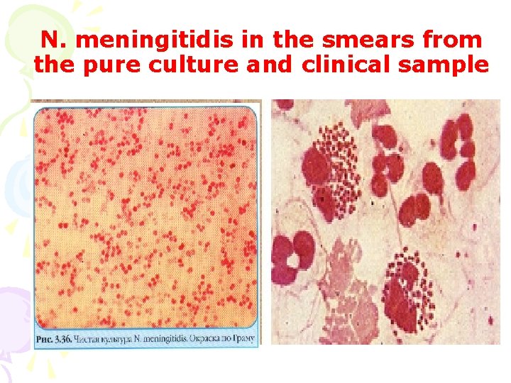N. meningitidis in the smears from the pure culture and clinical sample 