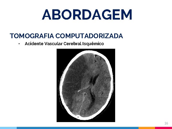 ABORDAGEM TOMOGRAFIA COMPUTADORIZADA • Acidente Vascular Cerebral Isquêmico 26 