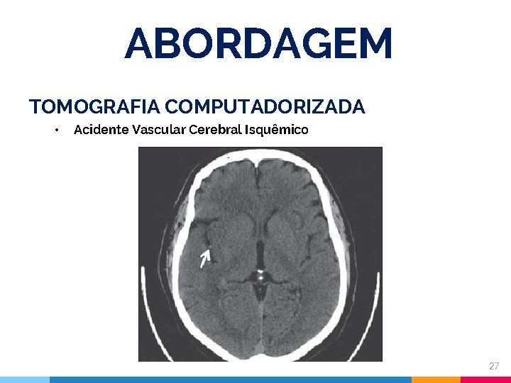 ABORDAGEM TOMOGRAFIA COMPUTADORIZADA • Acidente Vascular Cerebral Isquêmico 27 