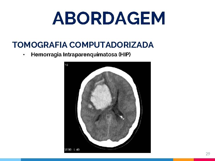 ABORDAGEM TOMOGRAFIA COMPUTADORIZADA • Hemorragia Intraparenquimatosa (HIP) 29 