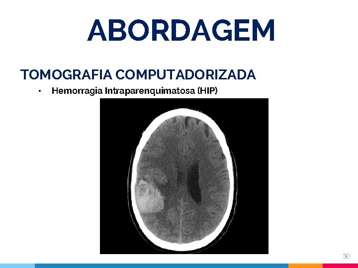 ABORDAGEM TOMOGRAFIA COMPUTADORIZADA • Hemorragia Intraparenquimatosa (HIP) 30 