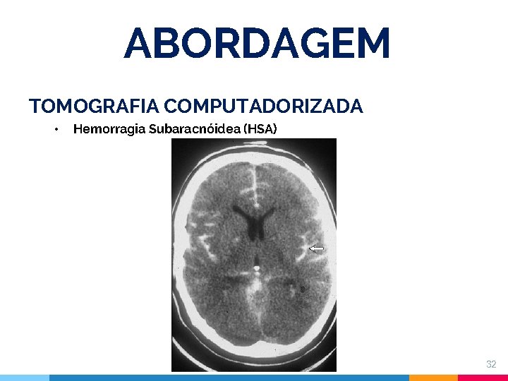 ABORDAGEM TOMOGRAFIA COMPUTADORIZADA • Hemorragia Subaracnóidea (HSA) 32 