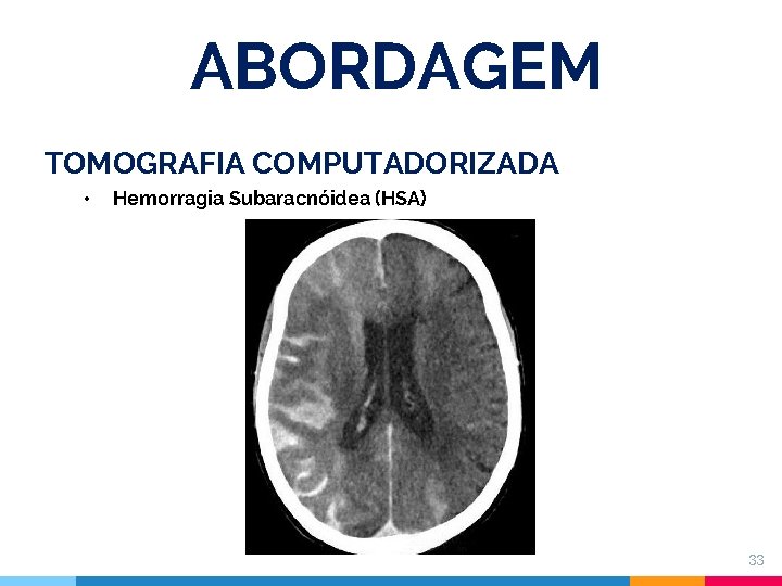 ABORDAGEM TOMOGRAFIA COMPUTADORIZADA • Hemorragia Subaracnóidea (HSA) 33 