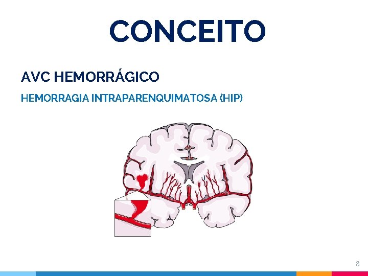 CONCEITO AVC HEMORRÁGICO HEMORRAGIA INTRAPARENQUIMATOSA (HIP) 8 