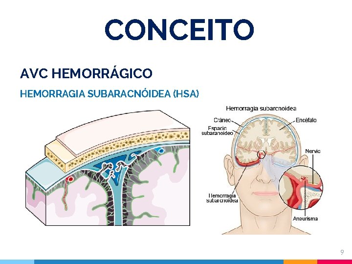CONCEITO AVC HEMORRÁGICO HEMORRAGIA SUBARACNÓIDEA (HSA) 9 