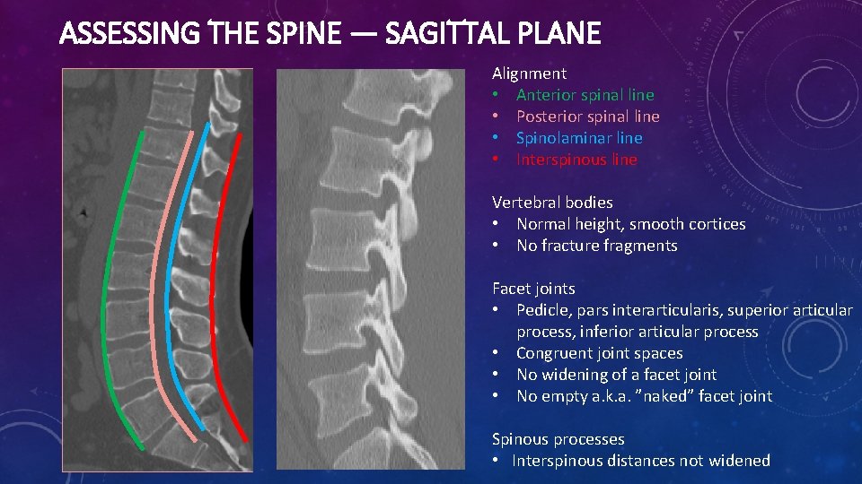 ASSESSING THE SPINE — SAGITTAL PLANE Alignment • Anterior spinal line • Posterior spinal