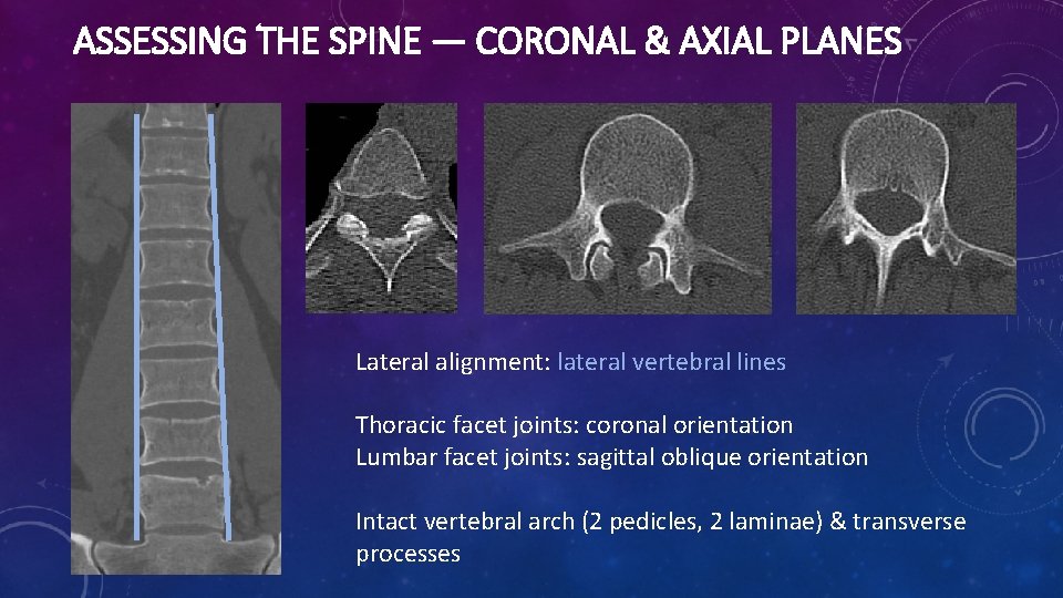 ASSESSING THE SPINE — CORONAL & AXIAL PLANES Lateral alignment: lateral vertebral lines Thoracic