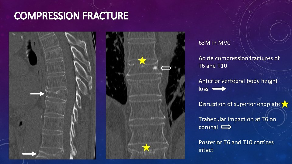 COMPRESSION FRACTURE 63 M in MVC Acute compression fractures of T 6 and T