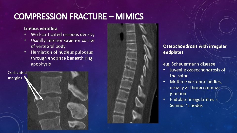 COMPRESSION FRACTURE – MIMICS Limbus vertebra • Well-corticated osseous density • Usually anterior superior